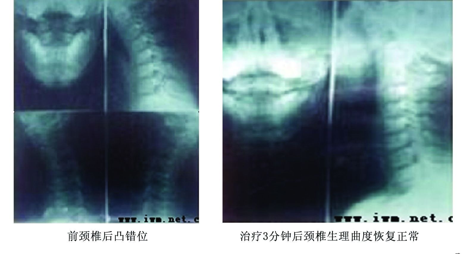 颈椎病 定向正骨法 正骨手法