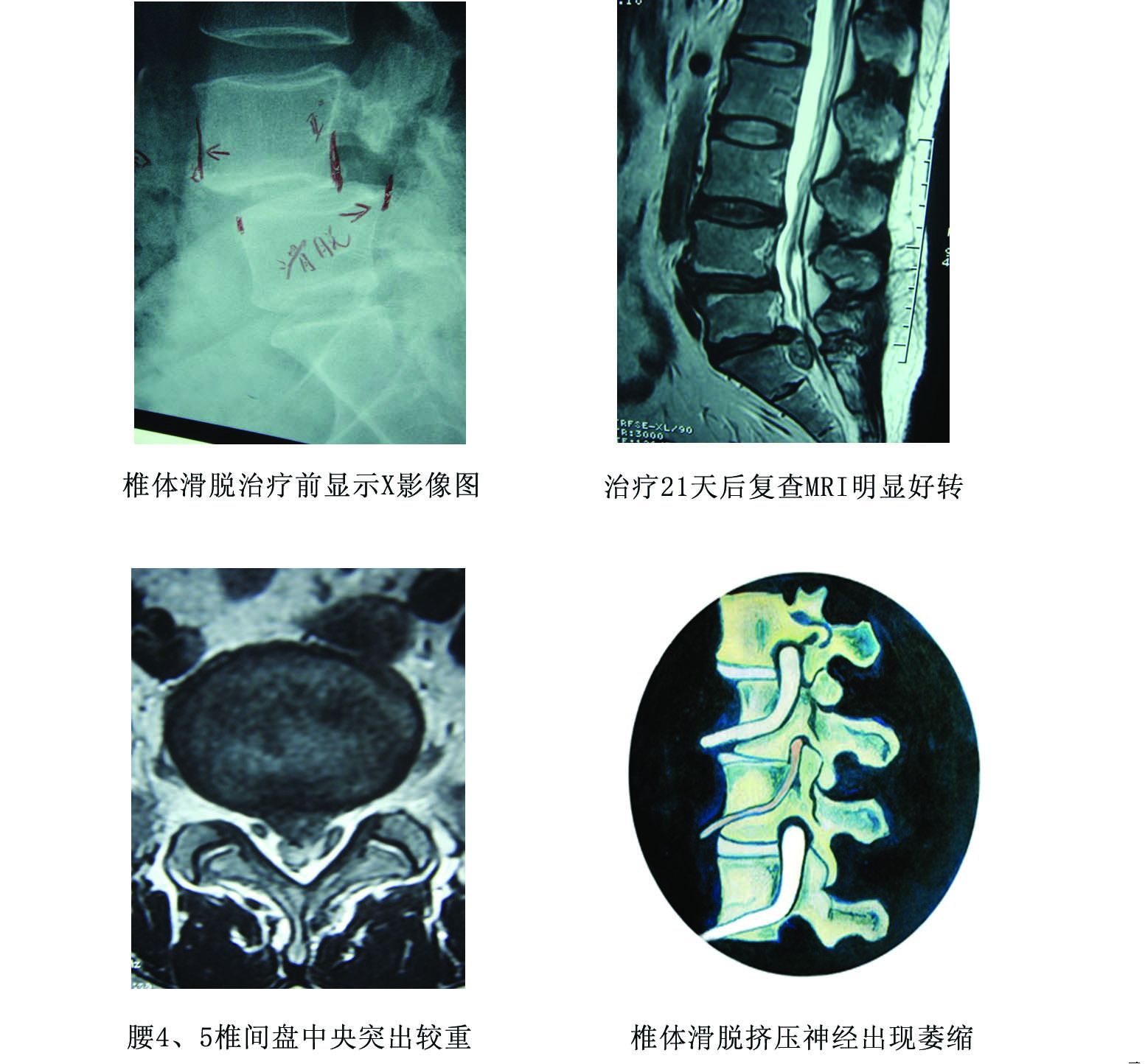 椎体滑脱 定向正骨法 正骨手法 腰椎