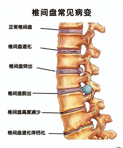 椎间盘常见病变 胡进江 定向正骨法