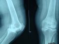 膝关节病变X线片有哪些常见的变化